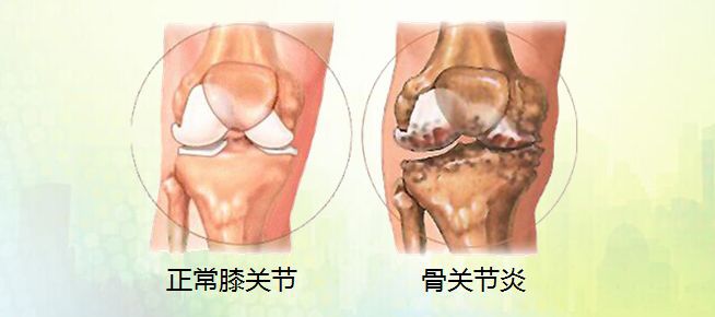 骨科科普 | 带您了解骨关节炎（一）