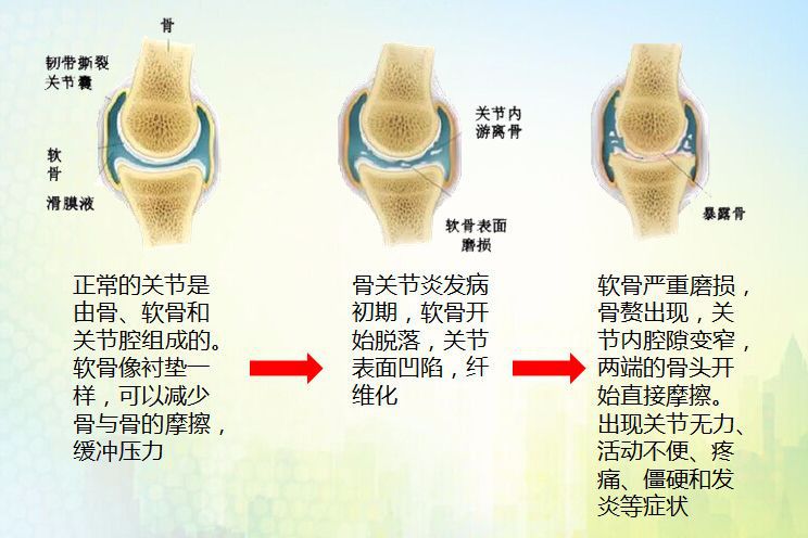 骨科科普 | 带您了解骨关节炎(一)