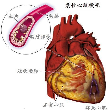 健康科普【心内科】|关“心”生命，认识心梗