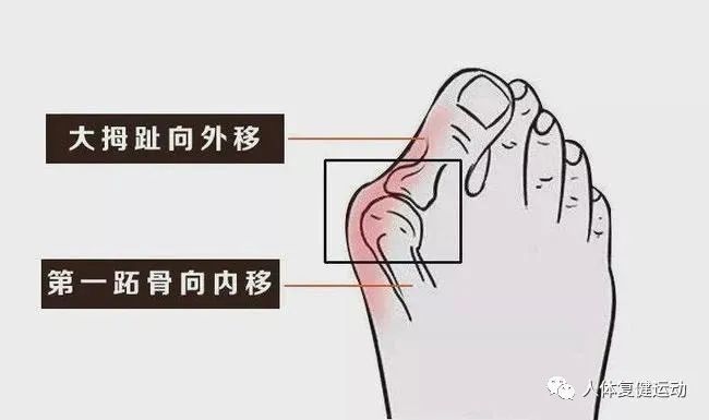 〖科普〗拇指外翻怎么办？如何纠正呢？