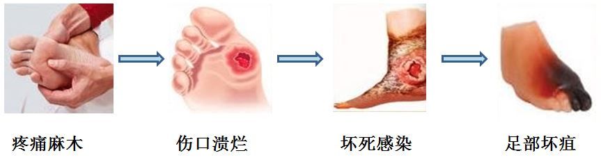 糖尿病足科普知识