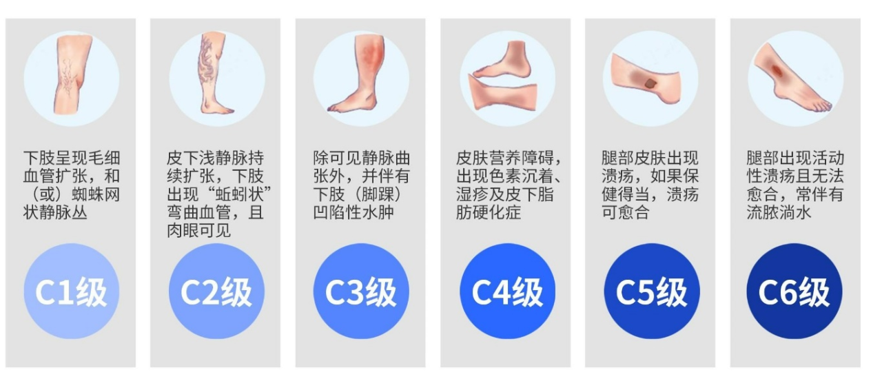 【科普】“蚯蚓腿”大揭秘：静脉曲张你要知道的事