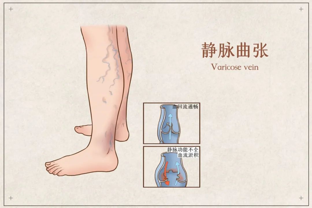 告别“蚯蚓腿”——下肢静脉曲张的治疗与预防