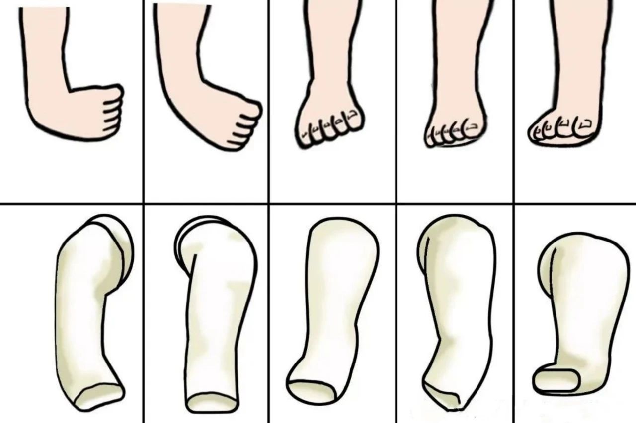 马蹄足内翻：你需要了解的病因、症状与治疗