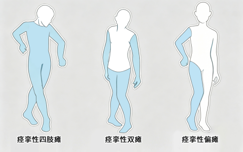 姿势异常?从缓解痉挛到矫正肢体畸形 ——重庆长城骨科医院痉挛性脑瘫专病诊疗介绍