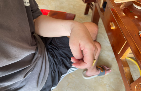 姿势异常?从缓解痉挛到矫正肢体畸形 ——重庆长城骨科医院痉挛性脑瘫专病诊疗介绍