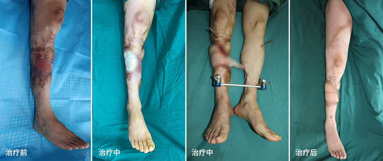 创面鳞状细胞癌怎么治？重庆长城骨科医院游离皮瓣技术修复小腿多年反复溃烂并恶变创面