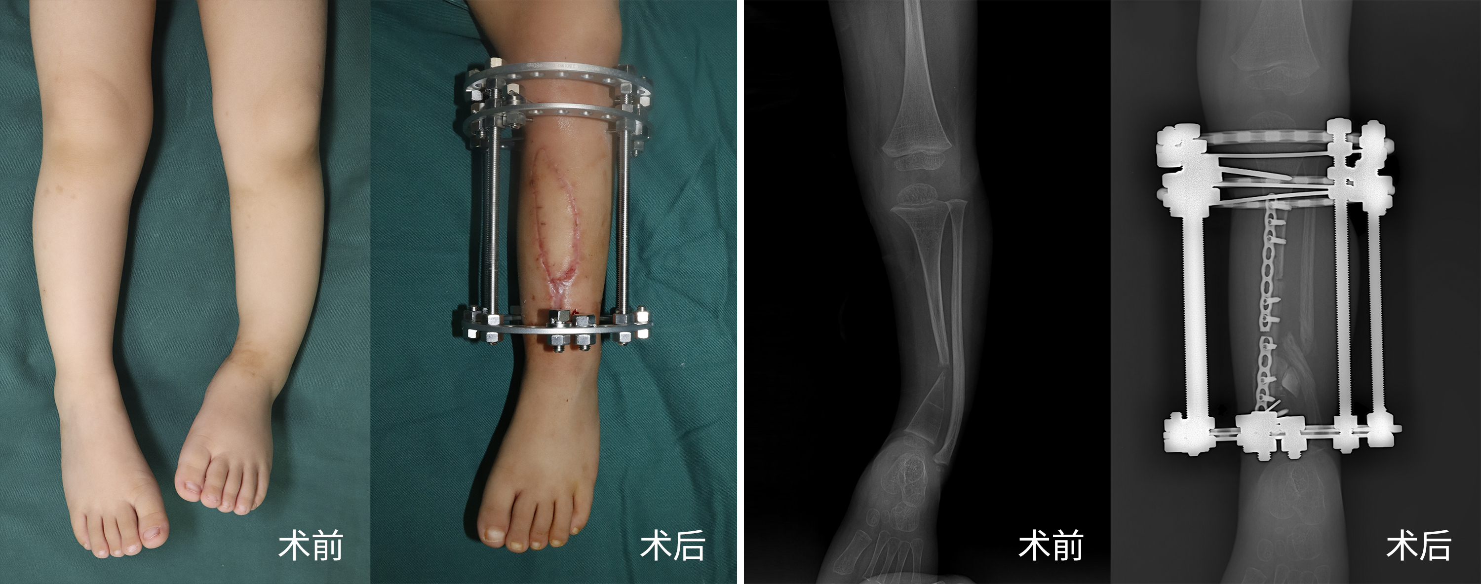 挑战世界级难题！重庆长城骨科医院完成院内首例先天性胫骨假关节肢体重建术，助力3岁男孩步履重启
